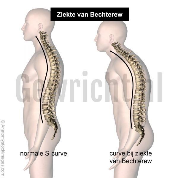 Ankylosing spondylitis