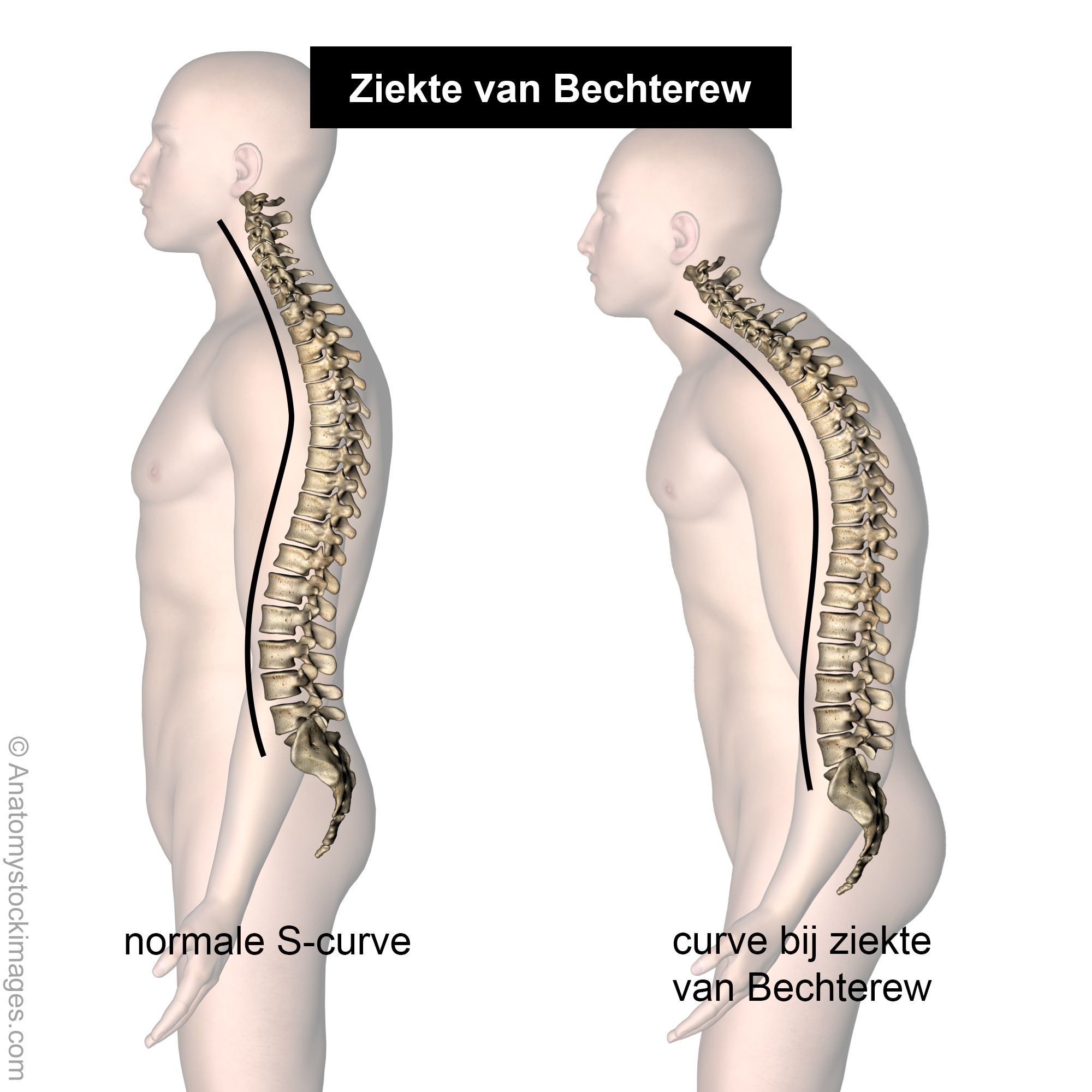 Ankylosing spondylitis
