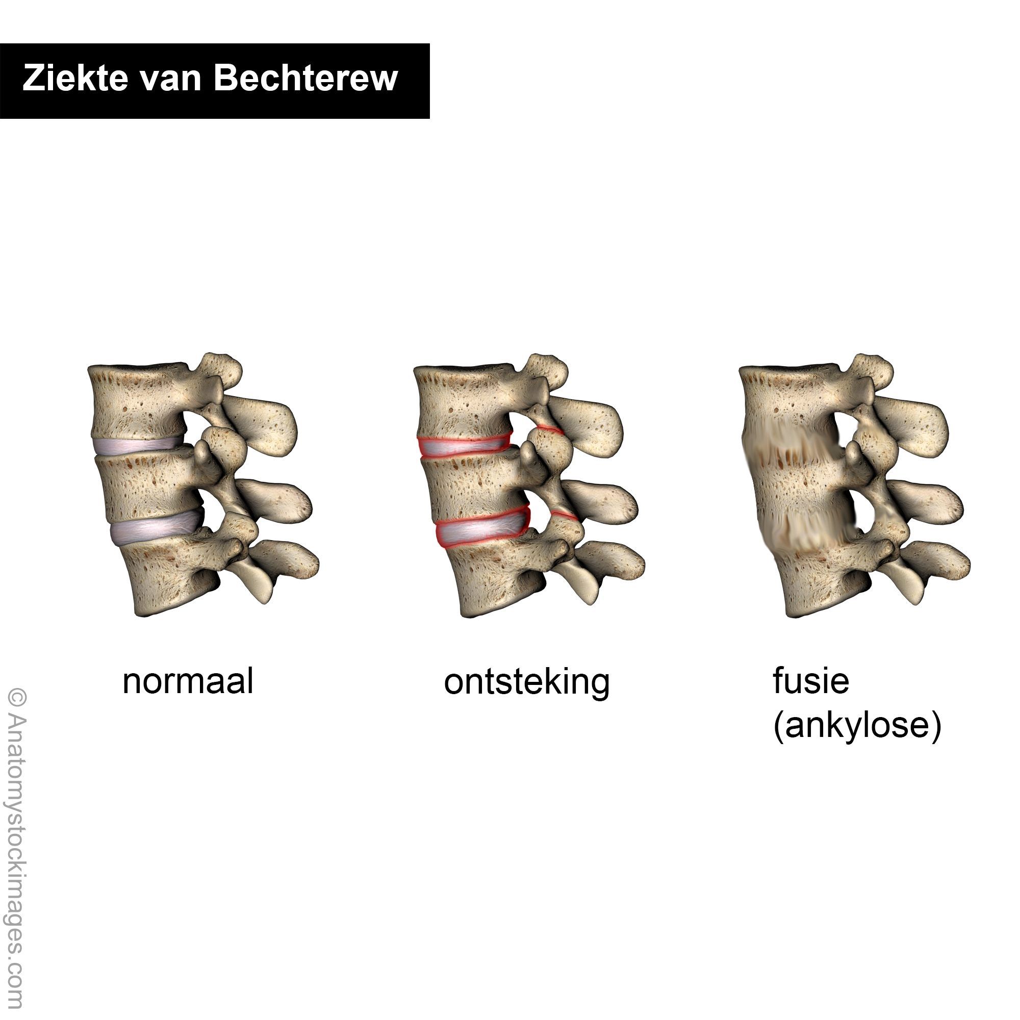 SA-vertebrae