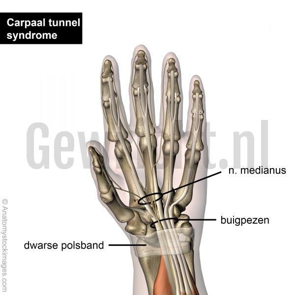 carpal_tunnel_synrome