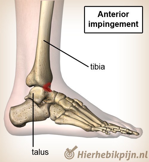 enkel-anterior-impingement