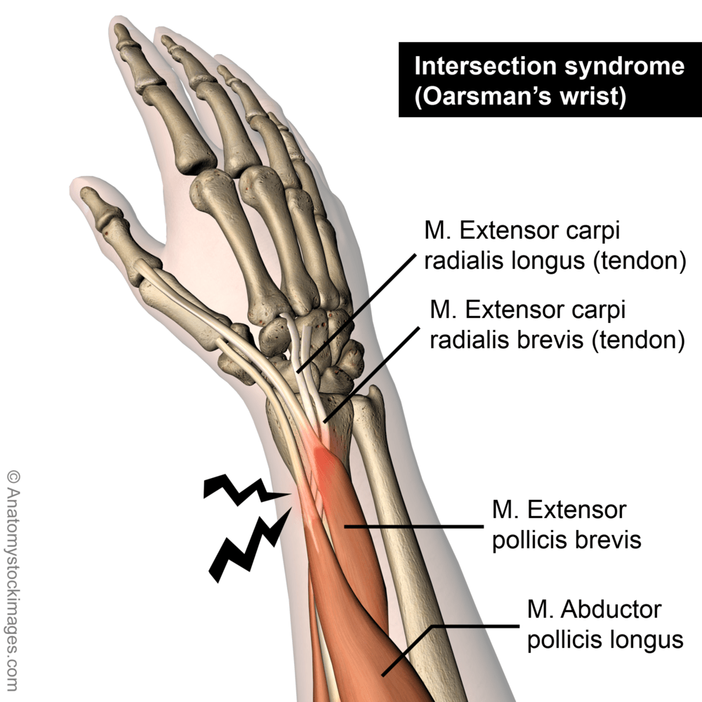 forearm-intersection-syndrome-oarsmans-wrist-musculus-extensor-carpi-radialis-longus-brevis-abductor-pollicis-back-skin-names