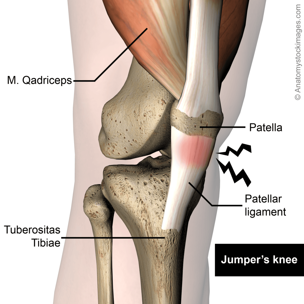 knee-jumpers-knee-jumper-pain-patellar-ligament-tendinitis-patella-quadriceps-tendon-tuberositas-tibiae-front-skin-names