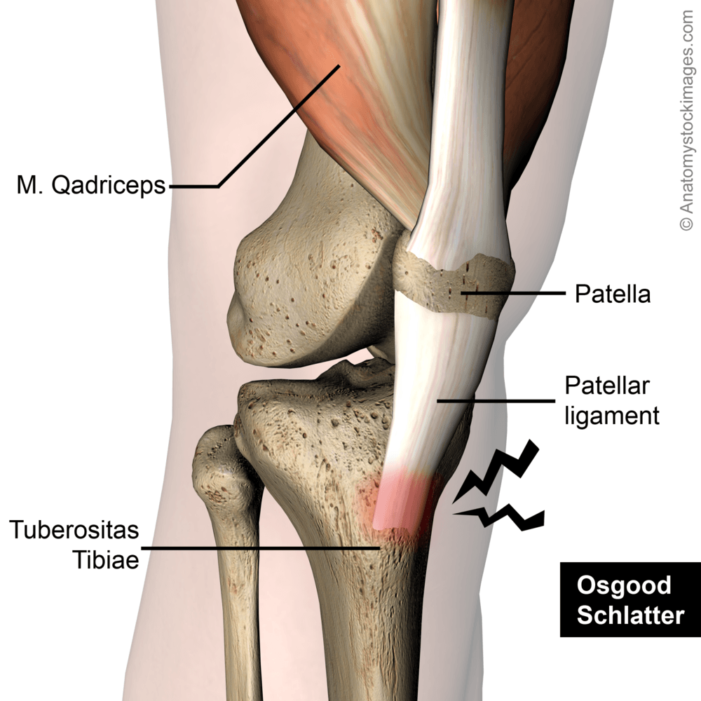 knee-osgood-schlatter-pain-patellar-ligament-tendinitis-patella-quadriceps-tendon-tuberositas-tibiae-front-skin-names