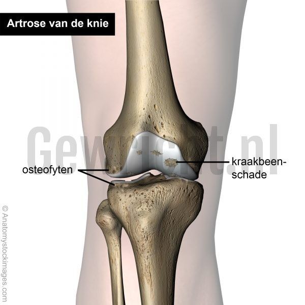 knie-artrose-kraakbeen