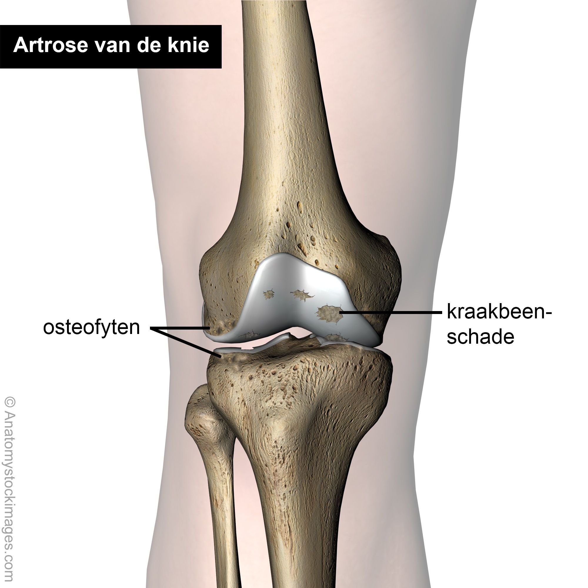 knie-artrose-kraakbeen