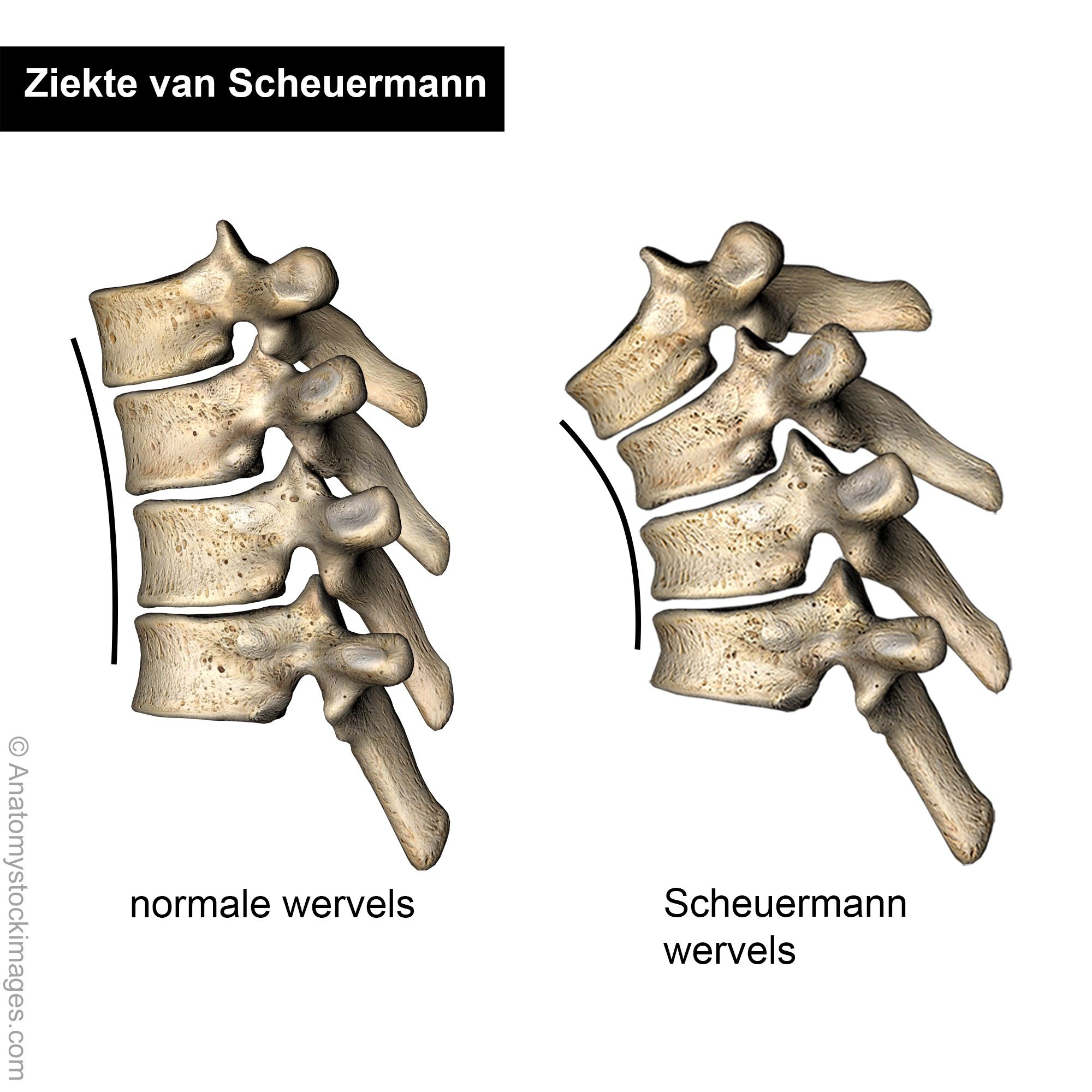 scheuermann-vertebrae