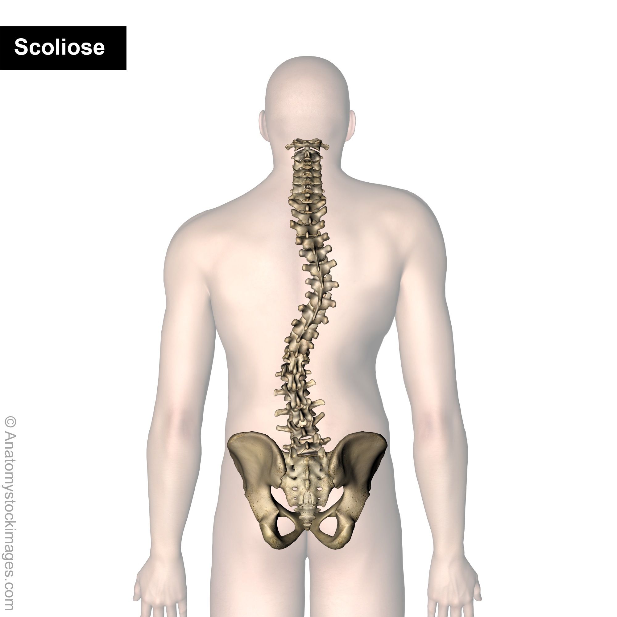 scoliose