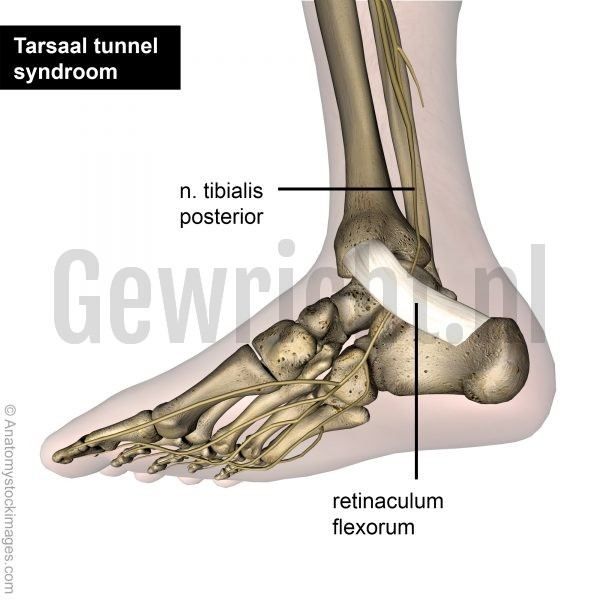 tarsal_tunnel_syndrome