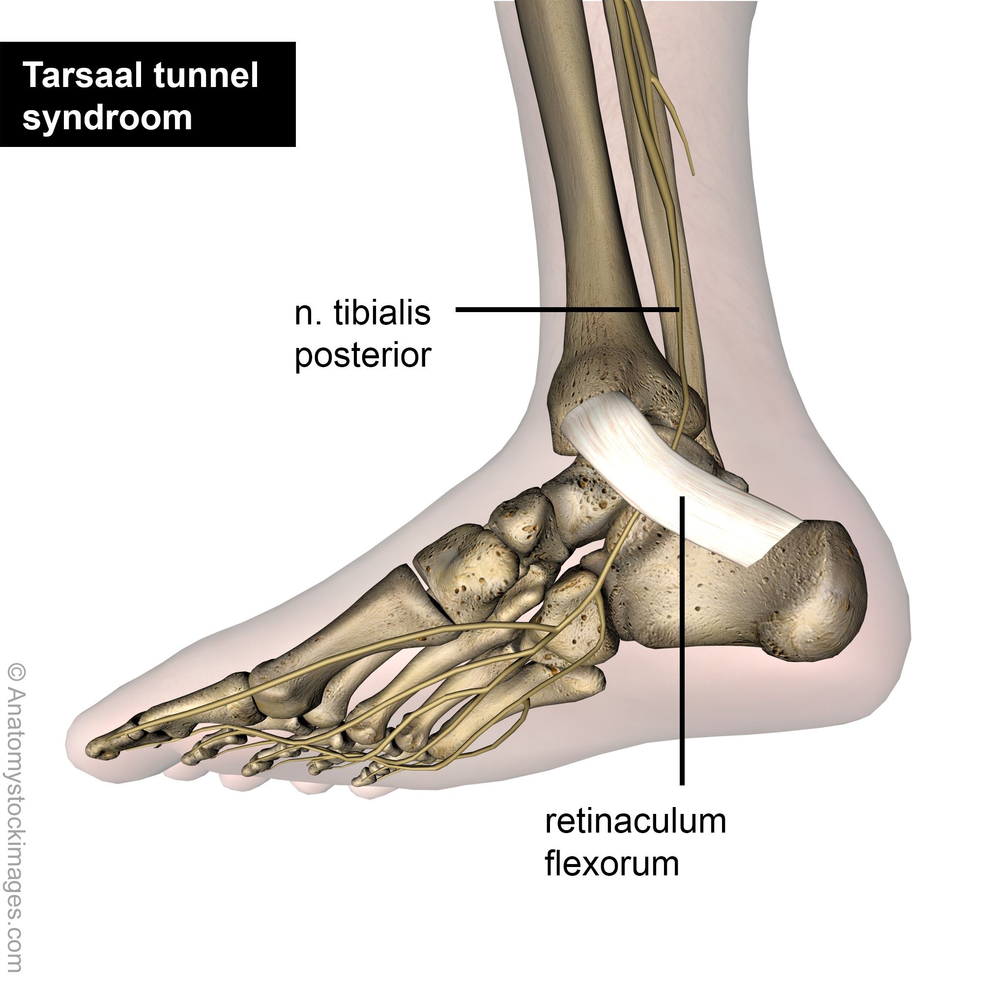 tarsal_tunnel_syndrome