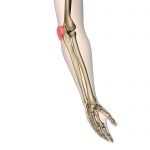 Bursitis olecrani - GEWRICHT.nl